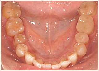 歯列矯正治療後　下顎