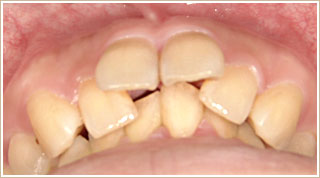 歯列矯正治療前　別角度