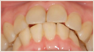 歯列矯正治療後　別角度