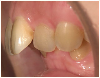 歯列矯正治療前　側面