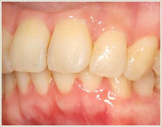 歯列矯正治療後　側面