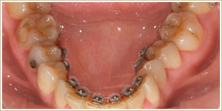 歯列矯正治療後7ヶ月　下顎