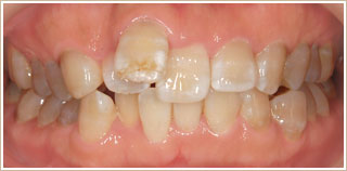歯が前に出ていた時の矯正　治療前　正面