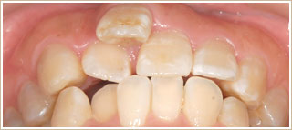 歯が前に出ていた時の矯正　治療前　上顎