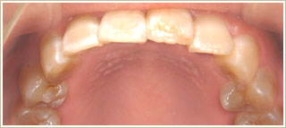 歯が前に出ていた時の矯正　治療後　上顎