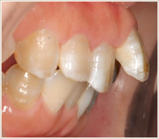 歯が前に出ていた時の矯正　治療前　側面