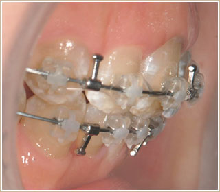 歯が前に出ていた時の矯正　治療後　側面