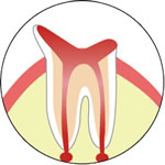 歯の構造　むし歯を除去するため歯隋を取り除いたイラスト