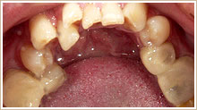 歯並びが悪い状態　治療前